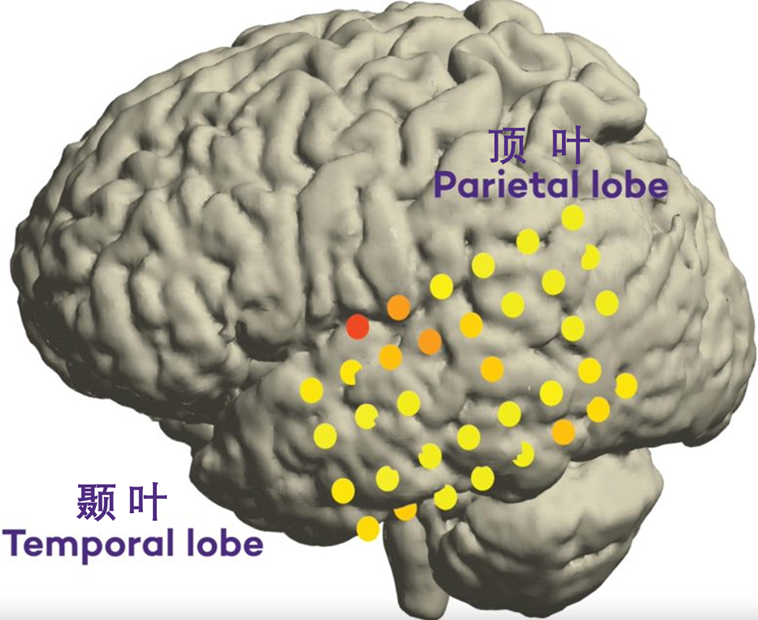 Scientists Identify Speech-Intent Signals Beyond the Frontal Lobe