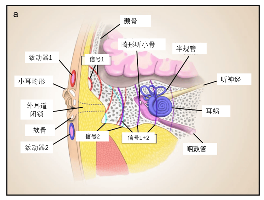 听力快讯丨新型柔性助听设备有望取代植入术-杭州听工场科技有限公司