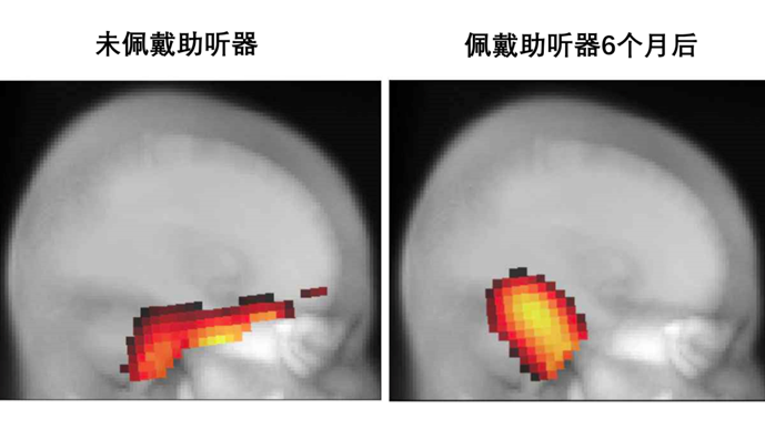 How the Brain Reallocates Sensory Processing After Hearing Loss